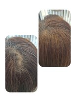 ユーフォルムギンザ(y-Forme Ginza)&nbsp;話題のトキカタ♪頭頂部編