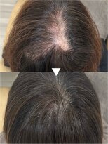 レヴィア(revia)&nbsp;育毛促進美髪コース半年後(月1回施術)の効果