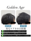 【　発　毛　ケ　ア　９　０　日　】Before＆After