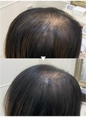 育毛促進美髪コース4ヶ月半後の効果[水戸/髪質改善/ヘッドスパ]