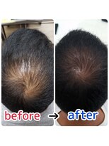 ブルーフィン シセロ(Blue Fin cicero) 頭皮改善!育毛促進ケア