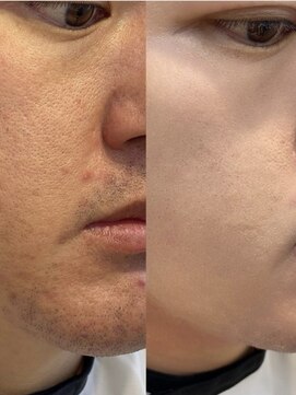 ハンナヘア(hanna hair) 韓国メイク