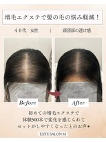 エクステサロンエム(EXTE SALON M)&nbsp;増毛エクステでびまん症透け感カバー/増毛エクステ/エアエク