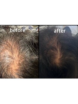 【毛量・髪のボリューム】でお悩みの方へ。韓国最先端美容技術を用いた育毛促進メニューを新たに導入☆