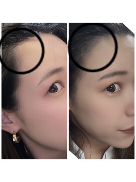 ヘアアトリエオット(hair atelier 8 otto) M字修正