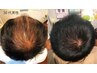 【メンズ10名限定】カット+頭皮環境改善ヘッドスパ ¥13,000→¥11,000