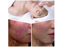 本気で肌改善をお考えの貴方。ハーブピーリングがおすすめです。