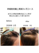 髪質改善 ソアリス 烏丸丸太町店(soiris)&nbsp;幹細胞培養上清液3ヶ月育毛促進コース・こめかみ細毛悩み