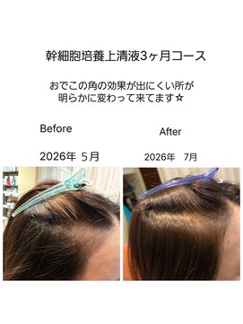 髪質改善 ソアリス 烏丸丸太町店(soiris) 幹細胞培養上清液3ヶ月育毛促進コース・こめかみ細毛悩み