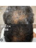 幹細胞を使用した育毛促進