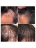 ◆PREMIUM強髪コース◆ヒト幹細胞培養液濃度100%強髪3ヶ月6回コース