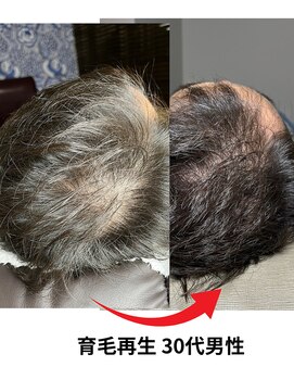 キヌ 銀座(KINU) 30代男性の育毛促進ケア