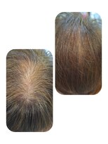 ユーフォルムギンザ(y-Forme Ginza)&nbsp;話題のトキカタ♪頭頂部編