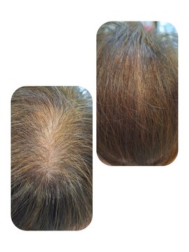 ユーフォルムギンザ(y-Forme Ginza) 話題のトキカタ♪頭頂部編