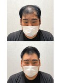 U字でお悩みの30代 ビフォアーアフター