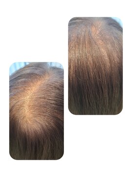 ユーフォルムギンザ(y-Forme Ginza) 話題のトキカタ♪頭頂部編