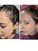ヘアアトリエオット(hair atelier 8 otto)&nbsp;ヘアライン修正