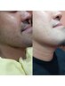 【大人気！男性限定】気になる体毛の処理をセルフで