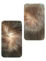 ユーフォルムギンザ(y-Forme Ginza)&nbsp;話題のトキカタ♪頭頂部編