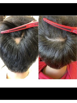 サンク エトワール(Cinq Etoiles) 頭皮改善ヘッドスパ