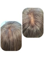 ユーフォルムギンザ(y-Forme Ginza)&nbsp;話題のトキカタ♪頭頂部編