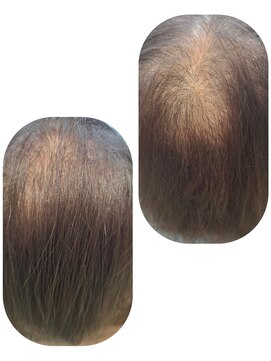 ユーフォルムギンザ(y-Forme Ginza) 話題のトキカタ♪頭頂部編