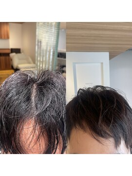 ベコ(Beco) 分け目ぱっくり割れ解消20代30代40代◎当店限定