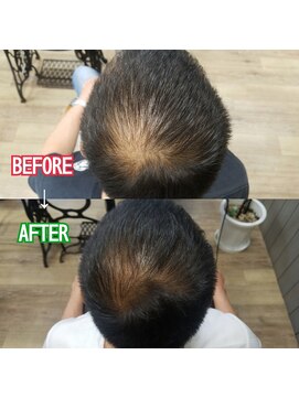 ルーミールーム(RoomieRoom) 頭皮改善の第一歩目