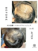 頭皮毛髪改善プログラム