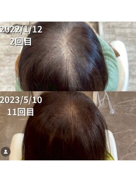 サルヴァトーレ 長崎 幹細胞を使用した育毛促進