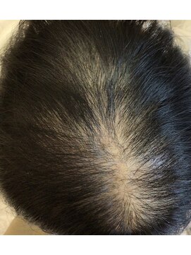 サーカス 銘苅店(circus) 【頭皮集中プレミアム】 本気のボリュームケア