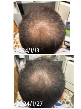 エミ(EMI) 育毛促進