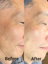 グラスヒビキ カット+メンズシェービングエステ+パーマ【悩み:乾燥】