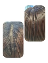 ユーフォルムギンザ(y-Forme Ginza)&nbsp;話題のトキカタ♪頭頂部編