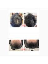スパセレーノ&nbsp;生え際の髪を育てる！