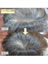 個室で受けられる育毛促進メニュー【強髪】ヒト幹細胞培養液を使用した最新のエイジングケアです