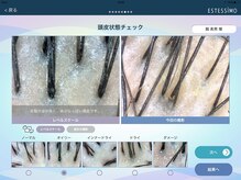 【Ai頭皮スコープ診断】ヘッドスパのメリットは？［ヘッドスパ/髪質改善/経堂］