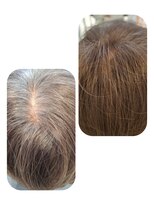 ユーフォルムギンザ(y-Forme Ginza)&nbsp;話題のトキカタ♪頭頂部編