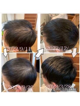 サルヴァトーレ 長崎 幹細胞を使用した育毛促進