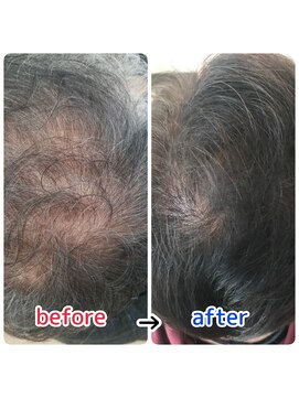 ブルーフィン シセロ(Blue Fin cicero) 頭皮改善！育毛促進ケア！20代30代40代50代