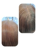 ユーフォルムギンザ(y-Forme Ginza)&nbsp;話題のトキカタ♪頭頂部編