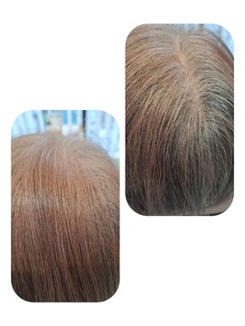 ユーフォルムギンザ(y-Forme Ginza) 話題のトキカタ♪頭頂部編