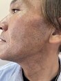 ヘアーサロン ポニー ヒゲ除毛before