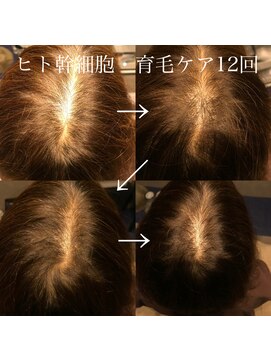 シー 豊川店(She) 幹細胞を使った育毛促進 30代、40代、50代