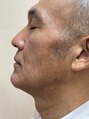 ヘアーサロン ポニー ヒゲ除毛10回after総額52200円