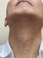 ヘアーサロン ポニー ヒゲ除毛10回after