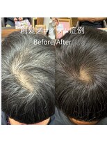 ハーティー(Hearty) 男性つむじ・分け目改善