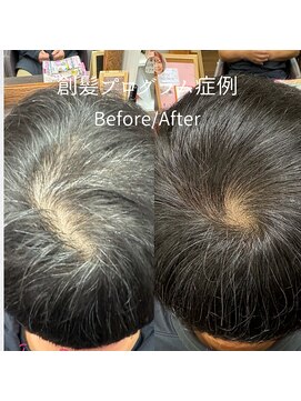 ハーティー(Hearty) 男性つむじ・分け目改善