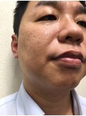 メンズ脱毛