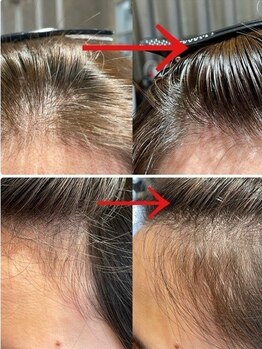 【高濃度ヒト幹細胞培養液使用】強髪プログラムNEOコース★さまざまな頭皮のお悩みにアプローチ！